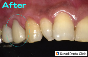 最新治療で奥歯は保険で白い歯
