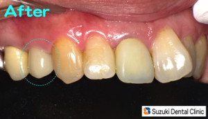 保険の銀歯、高額のセラミック、に代わる第３の白い歯