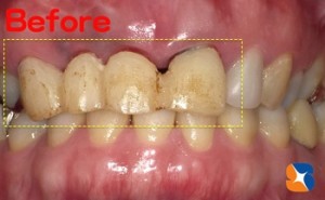 ブリッジの変色と形がおかしい