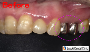 奥歯の銀歯を保険で白く出来る