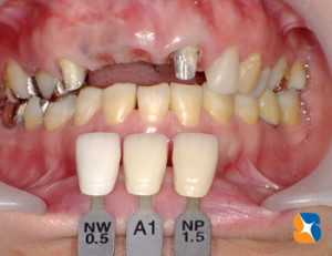 前歯が２本ないので４本連続のブリッジ