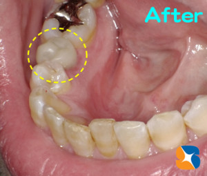 奥歯でも保険で白くできる