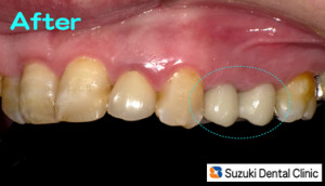 保険で奥歯に白い被せを入れる