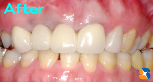 オールセラミックのブリッジを自作