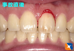 事故で前歯がグラグラ　抜歯を宣告される