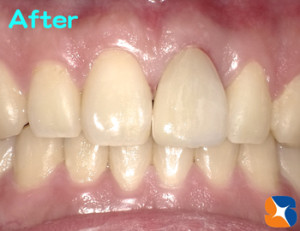 事故発症から７日後にオールセラミックを装着