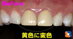 保険の前歯は黄色に変色する