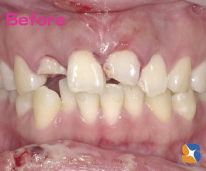 事故で前歯が折れる抜ける