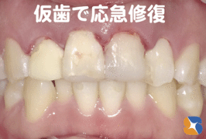 なんとか仮歯で修復　前途多難