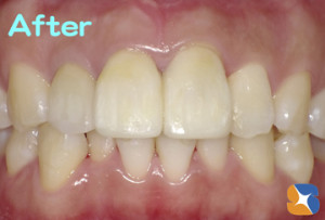 折れた歯をセラミックで修復