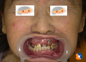 保険でよく噛める入れ歯の相談