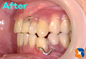 保険でよく噛める入れ歯の相談