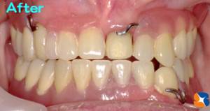 良く噛める入れ歯　見た目のよい入れ歯　東大阪