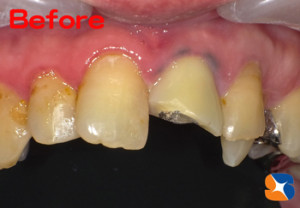 保険の前歯が割れた