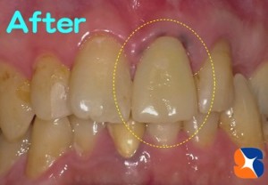その日のうちにDr．手作りのセラミックを装着