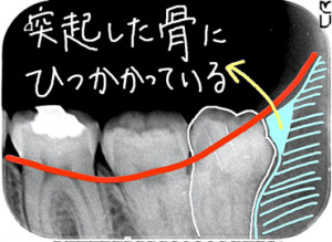 親知らずを局部的なレントゲンで撮影