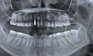 親知らずをお口全体のレントゲンでチェック