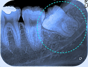 斜めに生える親知らず　神経を巻き込む