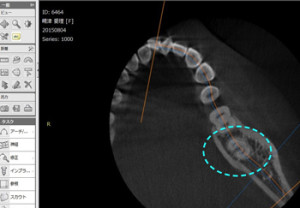 CTで親知らずを分析