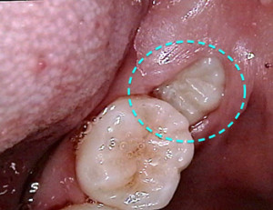 ビデオカメラで親知らずを撮影