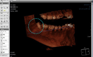 CTで親知らずを分析