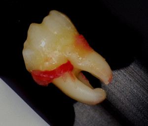 複雑な形をした親知らずの根