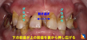 前歯が開いてグラグラ