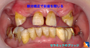 残せる歯は懸命に残す