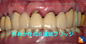 ６連結ブリッジセラミックが外れかけ