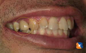 ２年前から保険で白く出来るようになりました