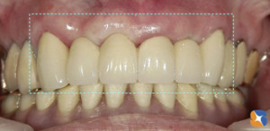 ６連結セラミックブリッジ