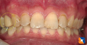 ２年前から保険で白く出来るようになりました