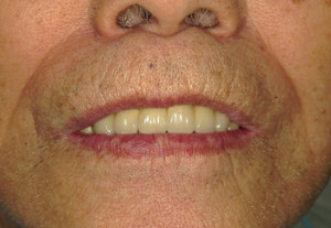 奈良　老人　セラミックのブリッジ