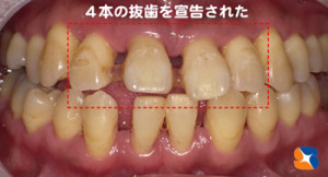 前歯　ブリッジ　６連結　東大阪　キレイ