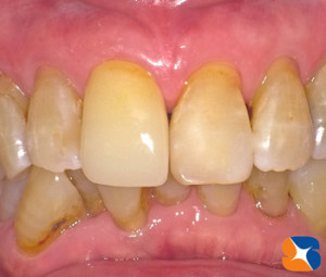 １日で前歯を完成させる