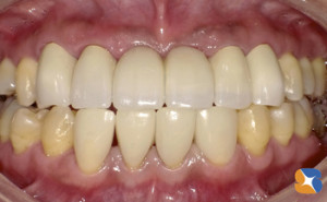 ６連結の前歯のブリッジ