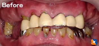 前歯のブリッジ　