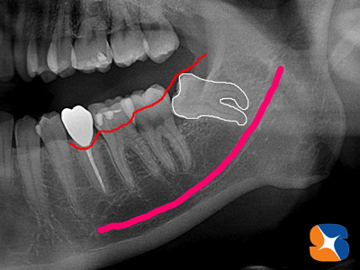 横向きの親知らず