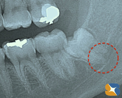 骨に埋まった親知らず