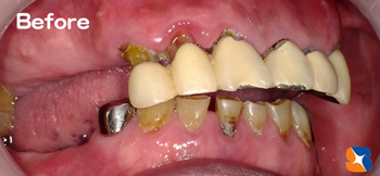 前歯のブリッジ