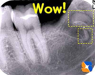 根の先はカーブを描き骨をホールド