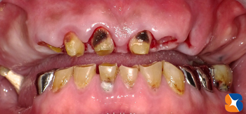 前歯のブリッジ