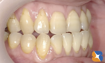 矯正前の歯並び