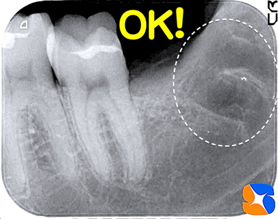 何が起こるか分からない親知らずの抜歯