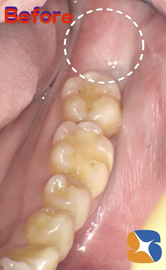 頭の一部も除いていない親知らず