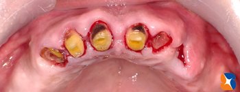 前歯のブリッジ