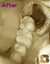 親知らずの抜歯直後