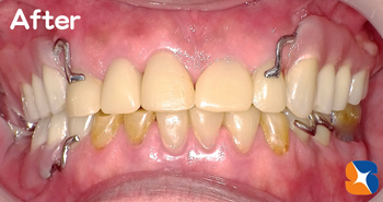 快適な入れ歯を装着