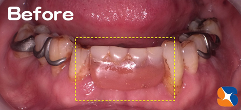 見た目の良くない入れ歯