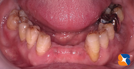 前歯に入れ歯を入れる